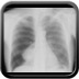 Right pneumothorax AP Chest X-ray