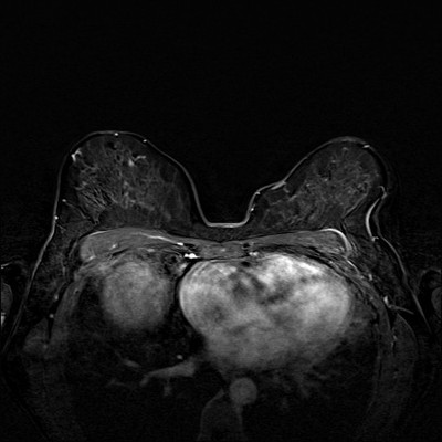 Carcinome canalaire in situ supéro-médian droit Soustraction 2 min