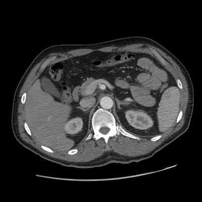 Subarachnoid Hemorrhage, Traumatic, Pneumothorax, Sternum fracture Chest, Abdomen and Pelvis, Axial plane, Arterial phase