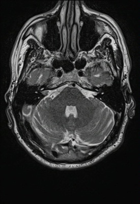 Schwannome cochléovestibulaire (neurinome de l'acoustique) T2 TSE AXIAL 2MM