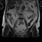 Cancer de l'endomètre latérofundique droit FIGO Ib Coronal T2 Grand Champ Cancer de l'endomètre latérofundique droit FIGO Ib Coronal T2 Grand Champ