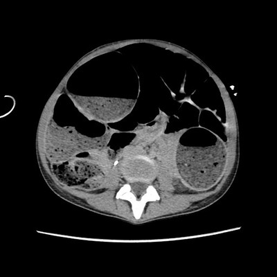 Occlusion mécanique colique sur endométriose digestive TDM Axial Tardif
