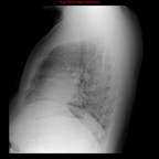 Pneumopathie interstitielle lymphoïde (LIP) Radiographie Thorax Pneumopathie interstitielle lymphoïde (LIP) Radiographie Thorax