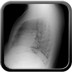 Pneumopathie interstitielle lymphoïde (LIP)  Radiographie Thorax