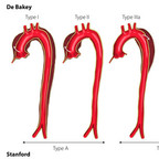 Aortic dissection Aortic dissection : Stanford and De Bakey Classifications Aortic dissection Aortic dissection : Stanford and De Bakey Classifications