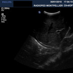 Pneumopathie basale droite. échographie base pulmonaire droite Pneumopathie basale droite. échographie base pulmonaire droite