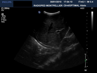 Pneumopathie basale droite. échographie base pulmonaire droite