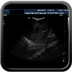 Pneumopathie basale droite. échographie base pulmonaire droite