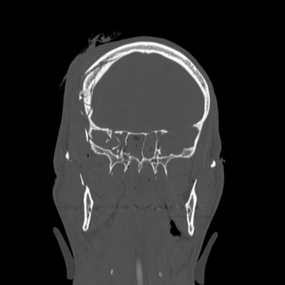 Severe cranioencephalic injuries, Carotid artery dissection, Aspiration pneumonia, Pelvic fracture Face CT, Coronal plane, Bone window