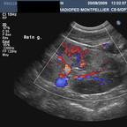 Pyélonéphrite aigüe non compliquée Echographie rénale Pyélonéphrite aigüe non compliquée Echographie rénale