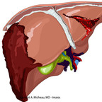 Hepatic trauma liver-injury-AAST-injury-scale Hepatic trauma liver-injury-AAST-injury-scale