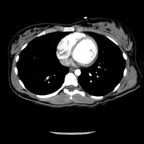 Fracture de Chance de L3 avec dissection post traumatique de l'aorte abdominale. Axial TAP artériel Fracture de Chance de L3 avec dissection post traumatique de l'aorte abdominale. Axial TAP artériel
