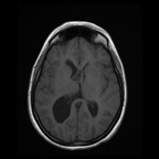 Central neurocytoma MRI Head Axial T1 FSE Central neurocytoma MRI Head Axial T1 FSE