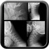 Subuxation atloïdo-axoïdiennes (C1-C2) Normal-atlantodental-distance-C1-C2