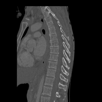 Traumatic perforation of small intestine, fracture of lumbar vertebra Dorsal spine, Sagittal plane, Bone window
