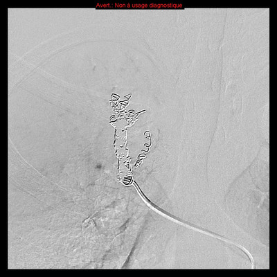 Hereditary hemorrhagic telangiectasia with lung arteriovenous malformation Embolization with coils