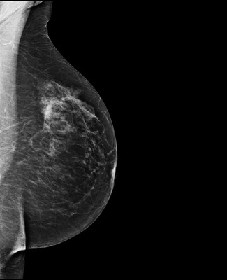 Asymétrie mammaire avec petit nodule dont l’aspect est en faveur d’un fibroadénome au sein d'un tissu glandulaire plus dense à droite. 4-LMLO