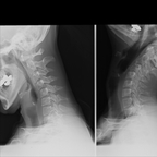 Arthrite érosive uncovertébrale cervicale Radiographies profil Arthrite érosive uncovertébrale cervicale Radiographies profil