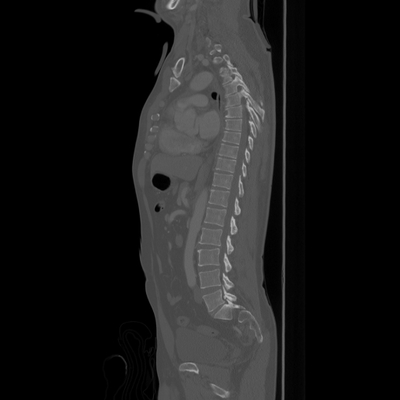 Subarachnoid Hemorrhage, Traumatic, Pneumothorax, Sternum fracture Sagittal plane, Dorsal and lumbar spine, Bone window