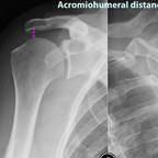 Rotator cuff rupture Acromiohumeral-distance-rotator-cuff Rotator cuff rupture Acromiohumeral-distance-rotator-cuff