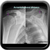 Rotator cuff rupture Acromiohumeral-distance-rotator-cuff