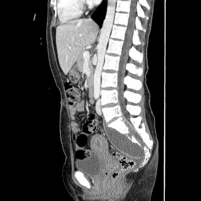 Tuberculose sacrée avec volumineux abcès Abdomen portal sagittal
