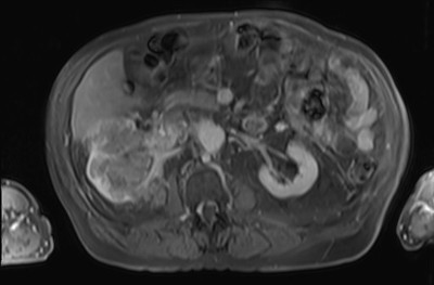 Adénocarcinome rénal droit avec envahissement de la veine rénale et de la VCI Tardif 5 min