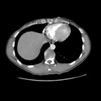Fracture instable de T12 en hyperflexion associant fracture tassement corporéal, fracture - luxation bilatérale des massifs articulaires et lésions disco-ligamentaires inter épineux, sur épineux et du ligament jaune. TAP Axial artériel Fracture instable de T12 en hyperflexion associant fracture tassement corporéal, fracture - luxation bilatérale des massifs articulaires et lésions disco-ligamentaires inter épineux, sur épineux et du ligament jaune. TAP Axial artériel