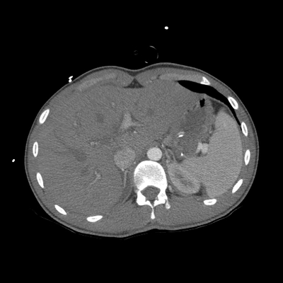 Craniocerebral trauma, Pulmonary edema, Renal injury Chest, Abdomen and pelvis, Arterial phase