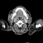 Carcinome épidermoïde jugal droit Axial Carcinome épidermoïde jugal droit Axial