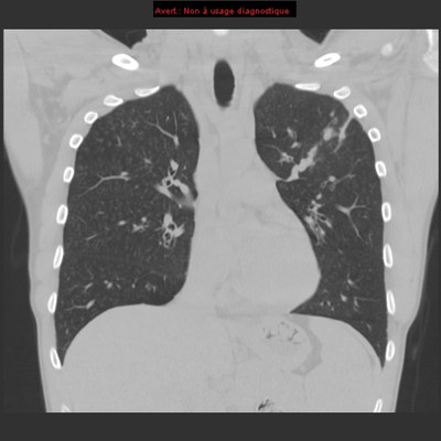 Déficit immunitaire commun variable : micronodules centrolobulaires sur bronchiolite  TDM Thorax Coronal