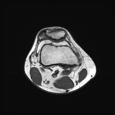 bipartite patella  MRI Lower limb Axial T1w