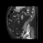 Diverticulite duodénale. TDM Abdomen Pelvis sagittal Temps veineux Diverticulite duodénale. TDM Abdomen Pelvis sagittal Temps veineux