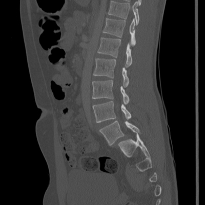 Thoracic Injuries, Spinal Injuries L5, Traumatic disc herniation Lumbar spine, Bone window, Sagittal plane