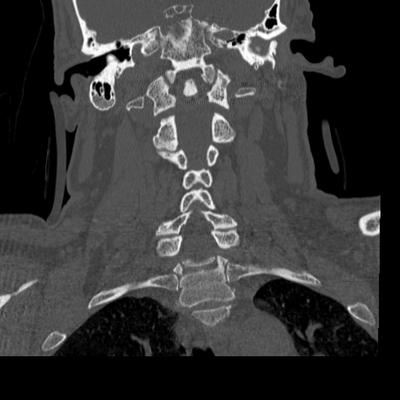 Subarachnoid Hemorrhage, Traumatic, Pneumothorax, Sternum fracture Cerviacl spine, Coronal plane, Bone window