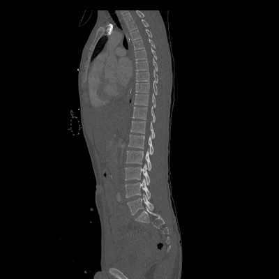 traumatisme cranien, oedème pulmonaire, lacération du rein TAP sagittal os