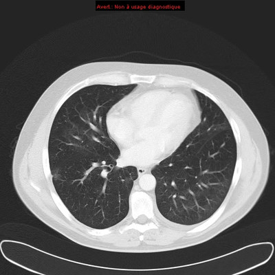 Tumeur maligne médiastinale antérieure (thymome B3) et myasthénie  TDM Thorax Axial Fenêtre Air