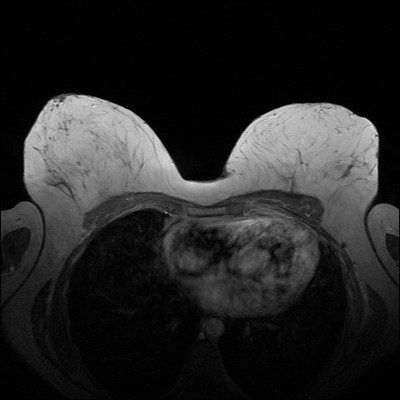 Récidive tardive de cancer du sein gauche Dynamique 1 min