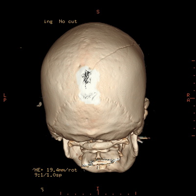 Severe cranioencephalic injuries, Carotid artery dissection, Aspiration pneumonia, Pelvic fracture 3D Head CT