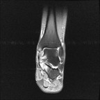 Entorse bilatérale de cheville avec rupture du ligament talo-fibulaire antérieur DP FS Coronal Entorse bilatérale de cheville avec rupture du ligament talo-fibulaire antérieur DP FS Coronal