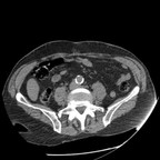 Volvulus gastrique organo-mésentérique axial abdomen sans IV Volvulus gastrique organo-mésentérique axial abdomen sans IV