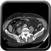 Volvulus gastrique organo-mésentérique axial abdomen sans IV