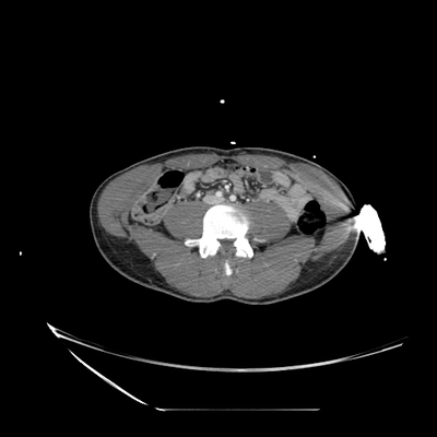 Cranioencephalic injuries, limb injuries, aspiration pneumonia Abdomen CT,  Portal venous phase, Axial plane