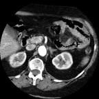 Insulinome pancréatique. TDM Abdomen Axial Temps artériel Insulinome pancréatique. TDM Abdomen Axial Temps artériel