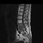 Spondylodiscite et arthrite postérieure IRM Sagittal T1 Spondylodiscite et arthrite postérieure IRM Sagittal T1