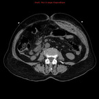 Saignement actif d'un anévrisme de l'artère hépatique sur surdosage en AVK TDM Abdomen Axial Sans injection Saignement actif d'un anévrisme de l'artère hépatique sur surdosage en AVK TDM Abdomen Axial Sans injection