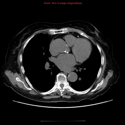 Pneumopathie interstitielle fibrosante à la cordarone  TDM Thorax Axial médiastin
