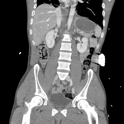 Cranioencephalic injuries, limb injuries, aspiration pneumonia Abdomen CT,  Portal venous phase, Coronal plane