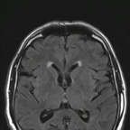 Neurinome cochléo-vestibulaire intra canalaire IRM Crâne Axial FLAIR Neurinome cochléo-vestibulaire intra canalaire IRM Crâne Axial FLAIR
