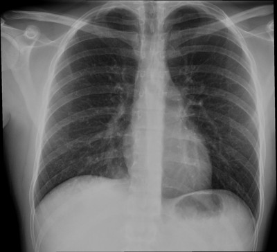 Pneumopathie infectieuse de la base droite Thorax Face